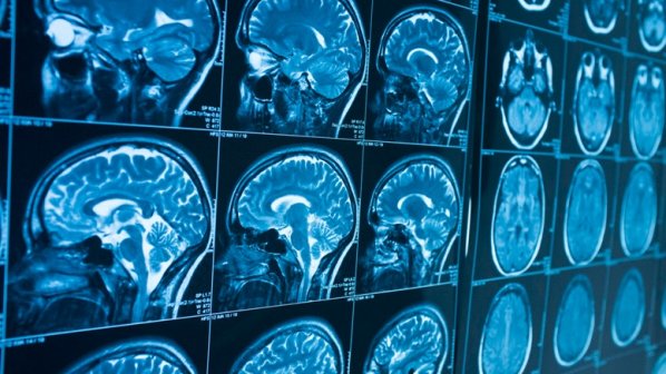 هوش مصنوعی ده سال زودتر از بروز نشانه‌ها، آلزایمر را تشخیص می‌دهد